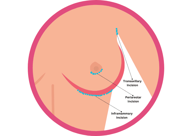 Breast Augmentation in Beverly Hills | Los Angeles Breast Enhancement