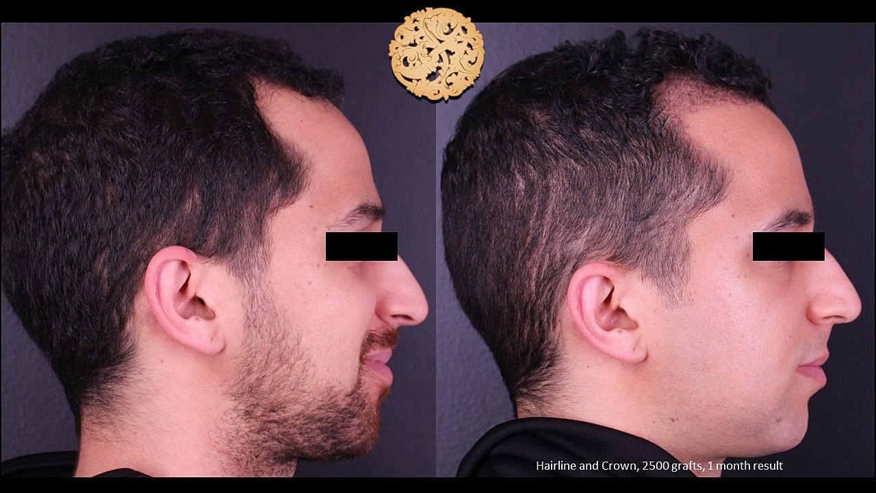 Before and after hair transplant progress results.