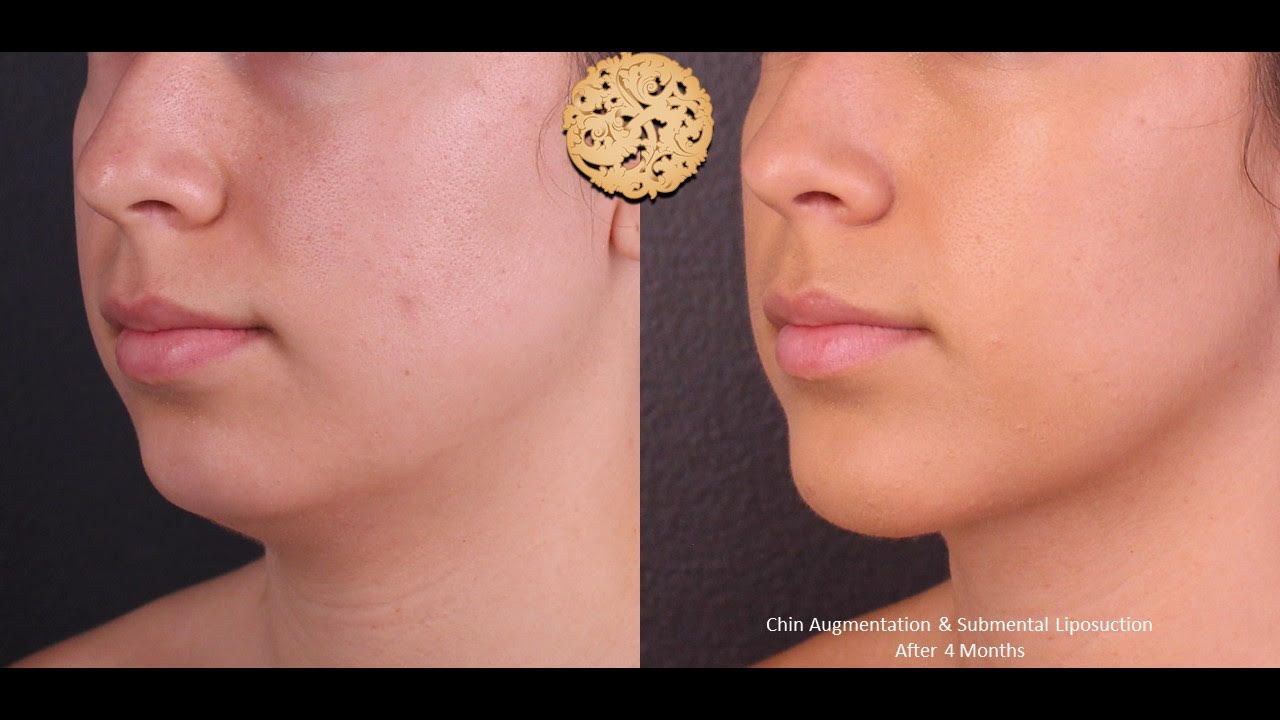 Chin Lipsouction Before & After