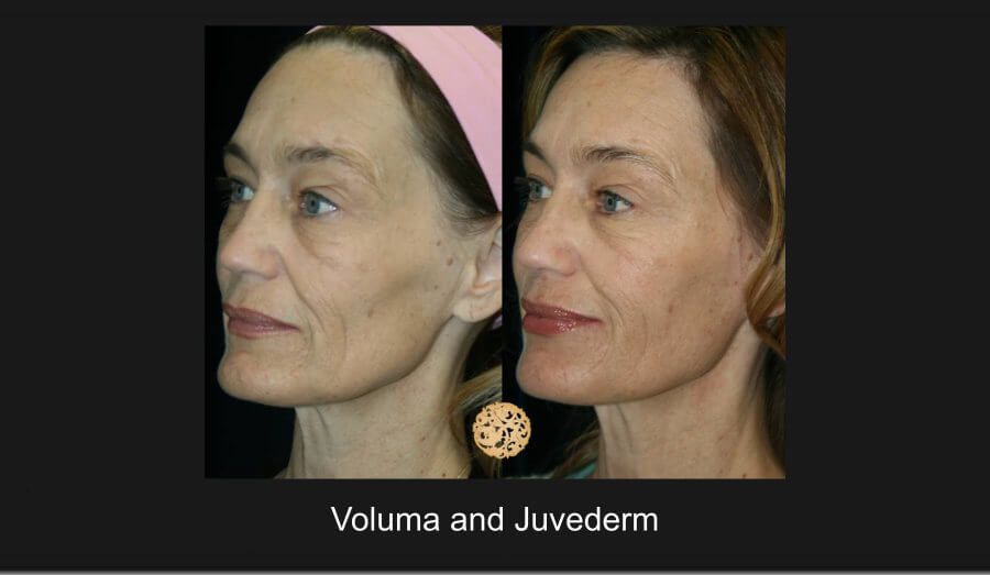 Temple Fillers Before & After