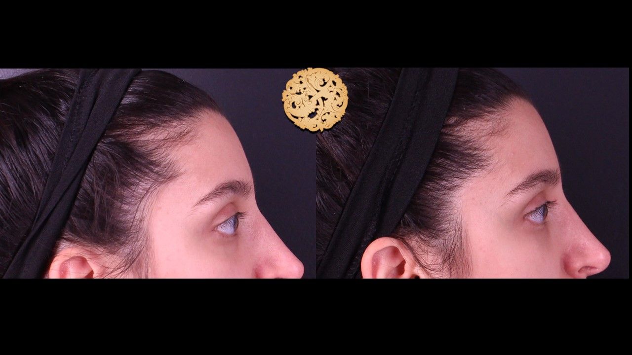 Temple Fillers Before & After