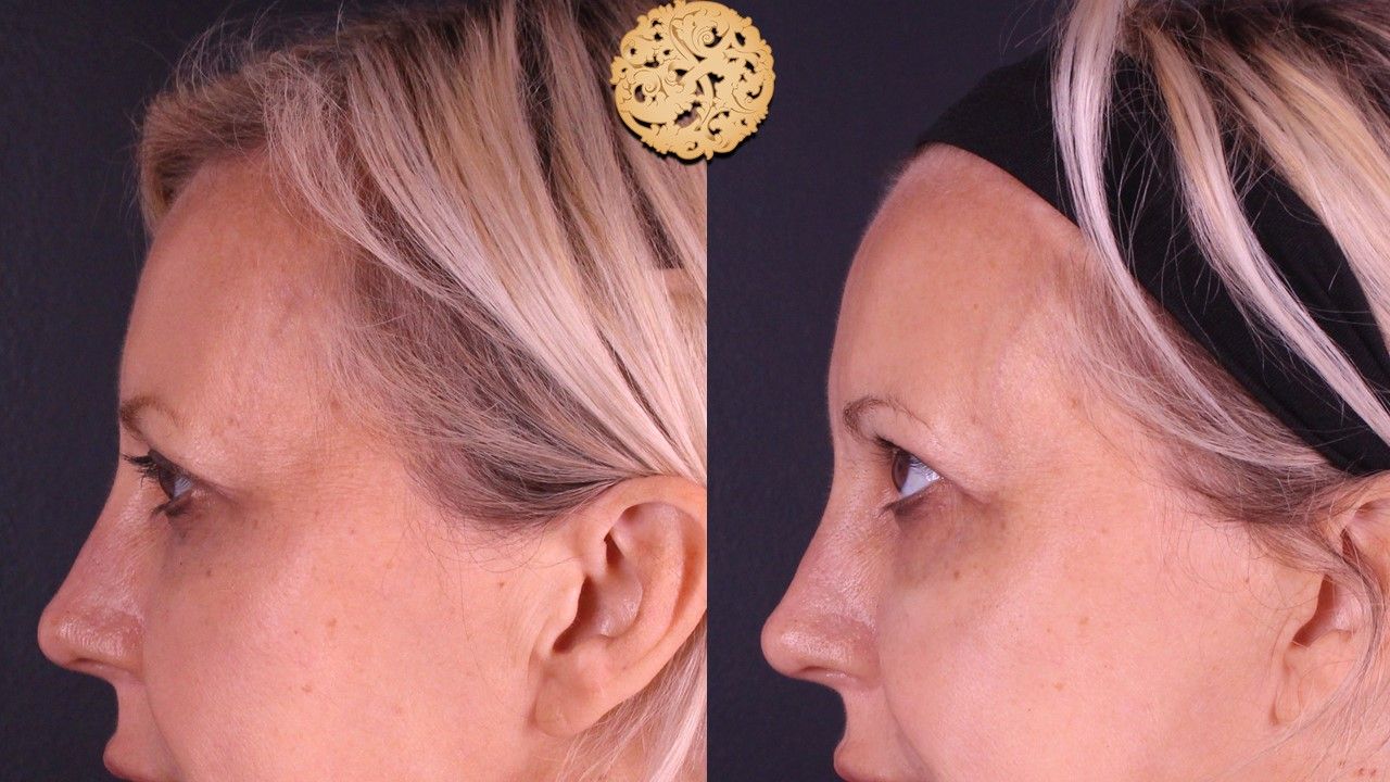 Temple Fillers Before & After
