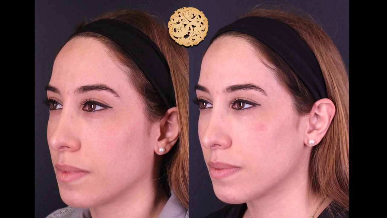 Temple Fillers Before & After