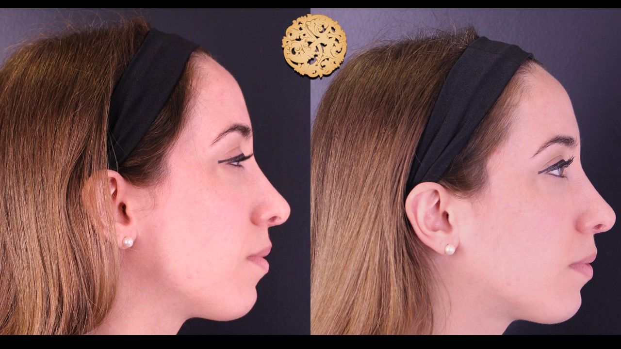 Temple Fillers Before & After