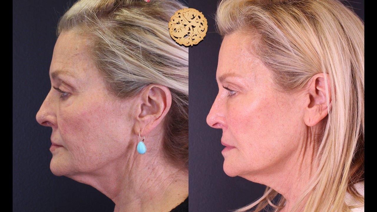 Temple Fillers Before & After