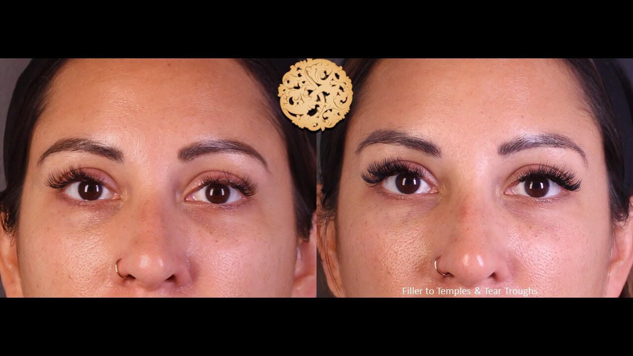 Temple Fillers Before & After