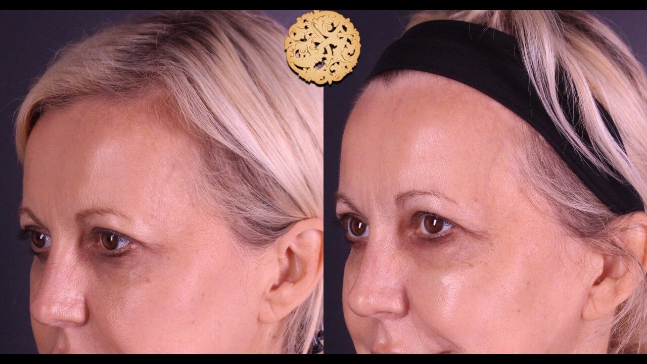 Temple Fillers Before & After