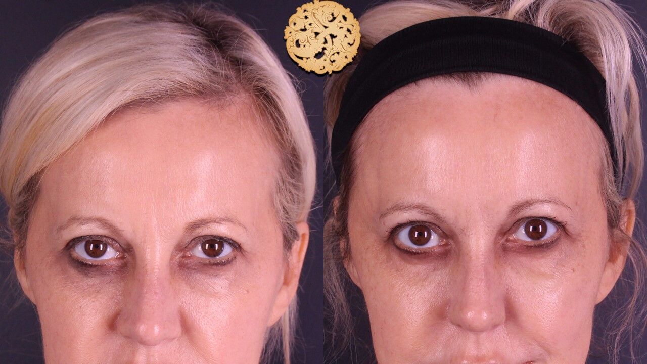 Temple Fillers Before & After
