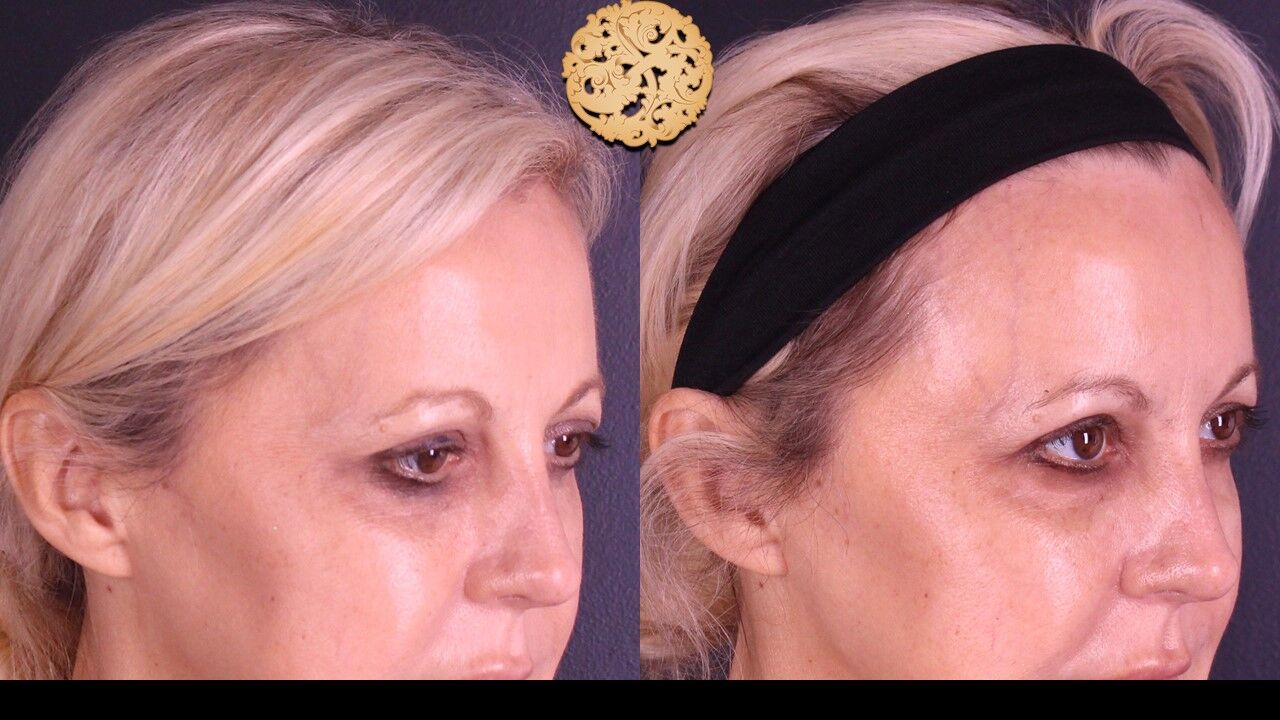 Temple Fillers Before & After