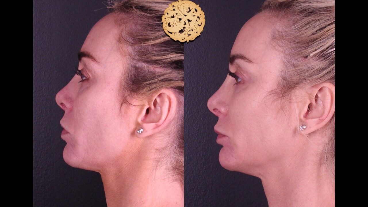 Temple Fillers Before & After