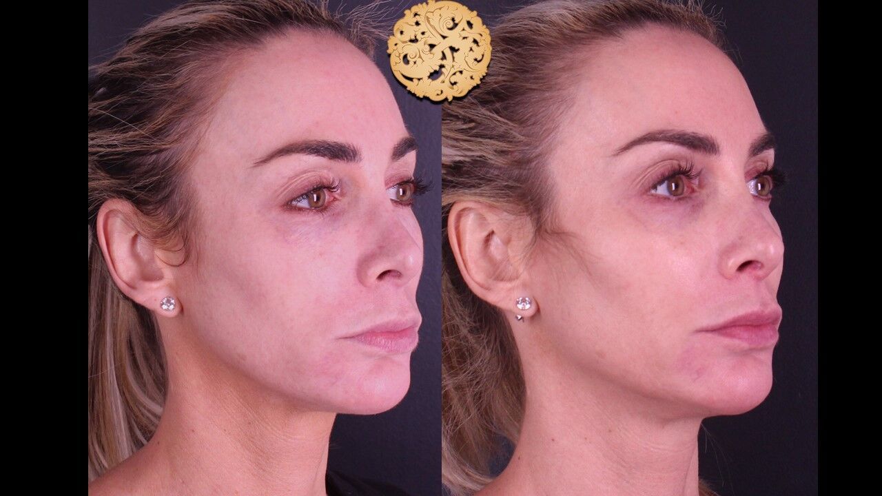 Temple Fillers Before & After