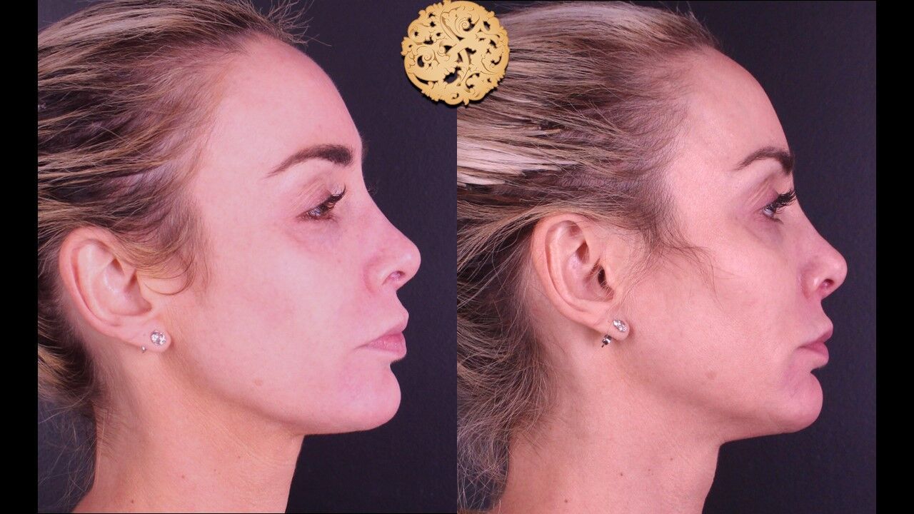 Temple Fillers Before & After