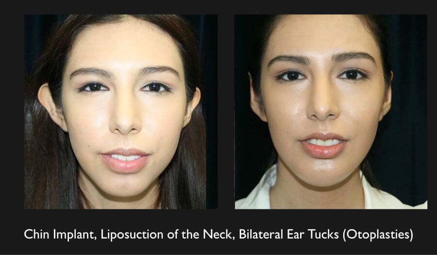 Otoplasty Before & After