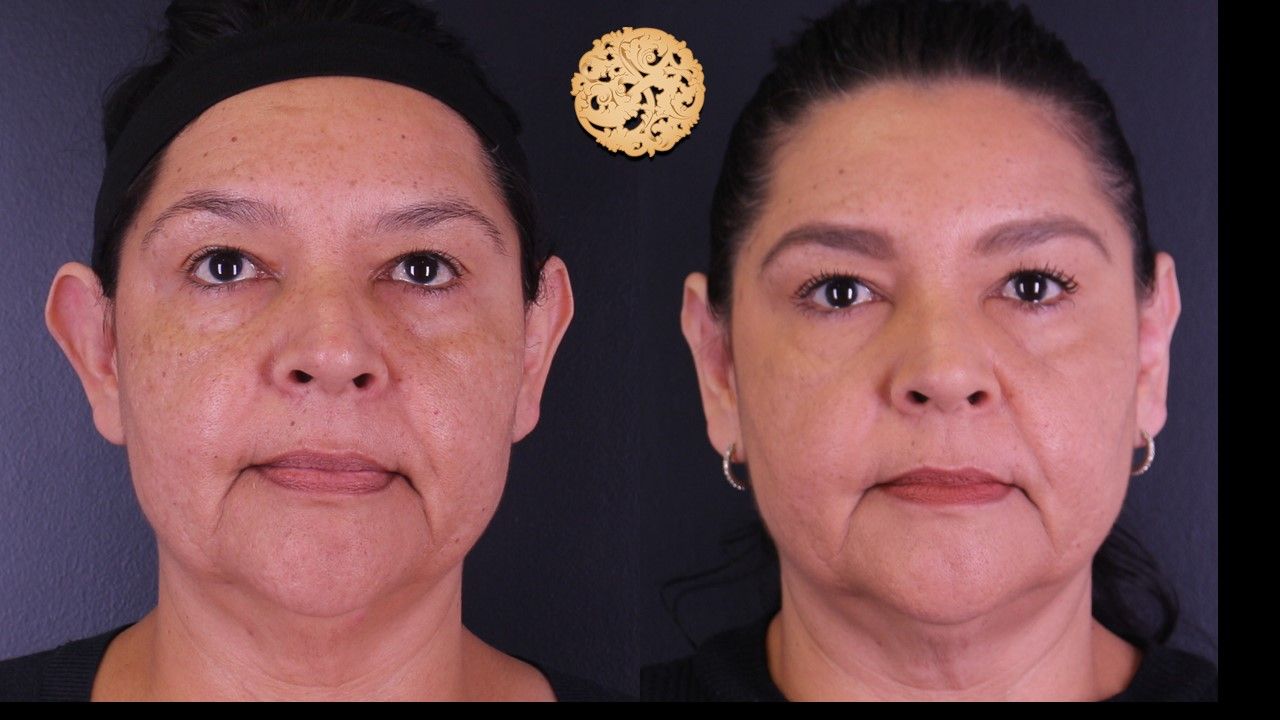 Otoplasty Before & After