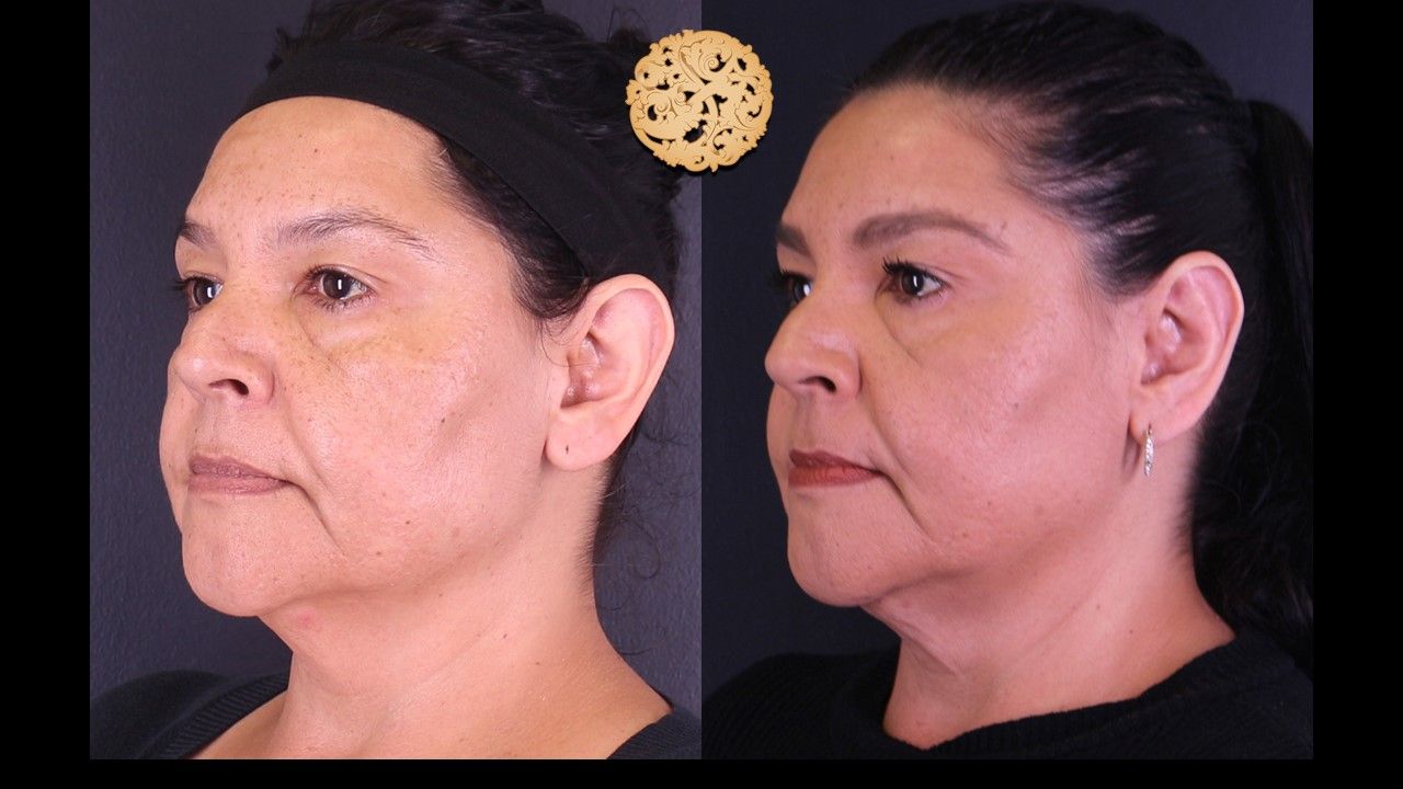 Otoplasty Before & After