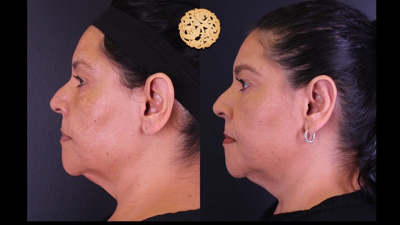 Otoplasty Before & After