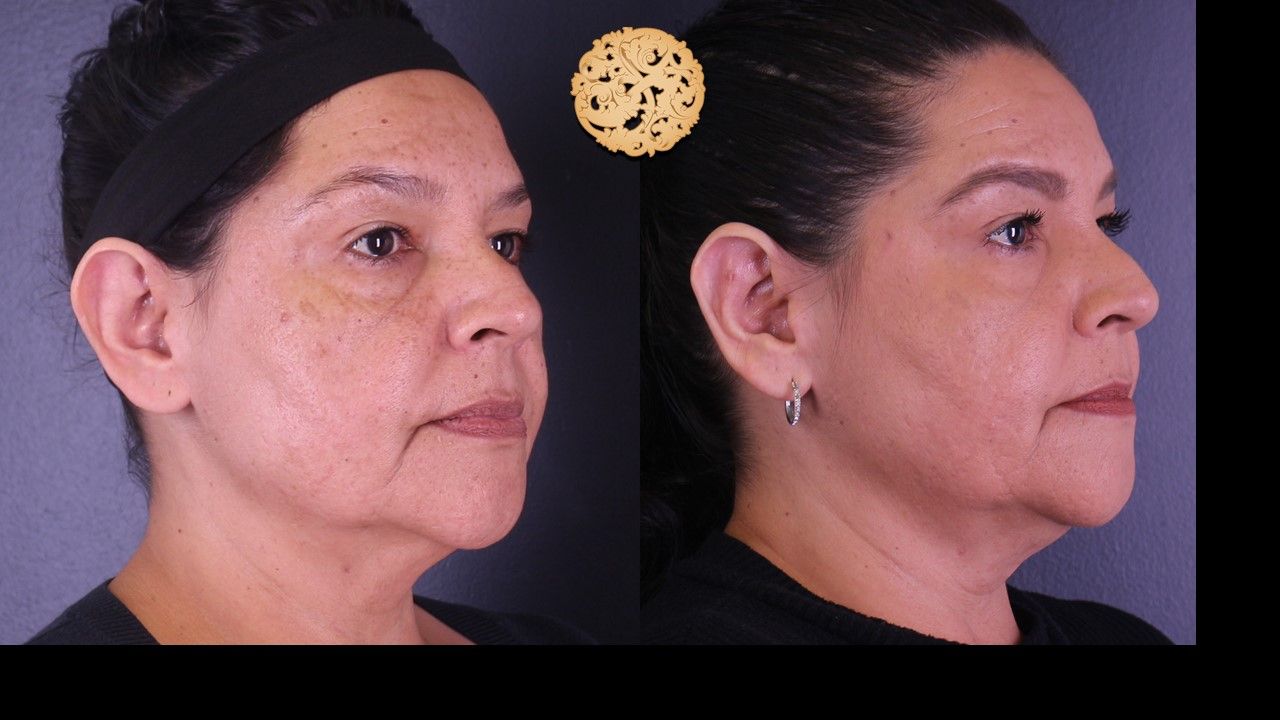 Otoplasty Before & After