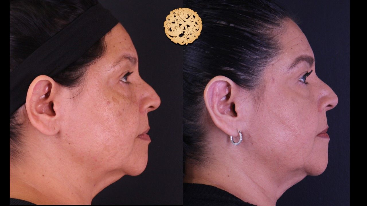 Otoplasty Before & After