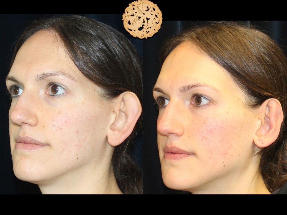 Otoplasty Before & After
