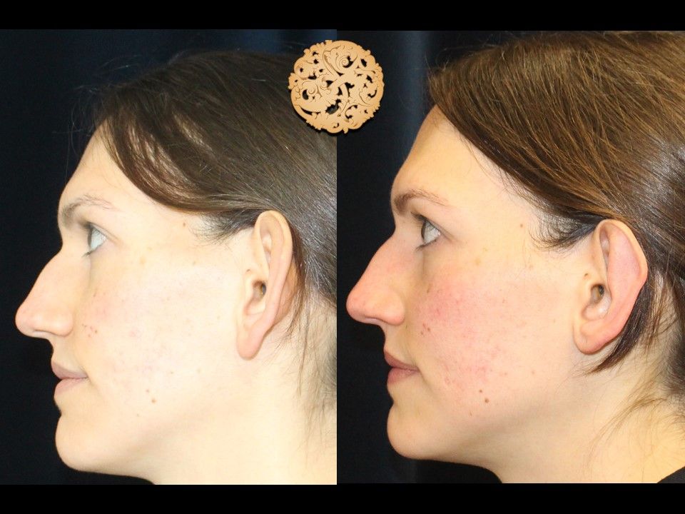 Otoplasty Before & After