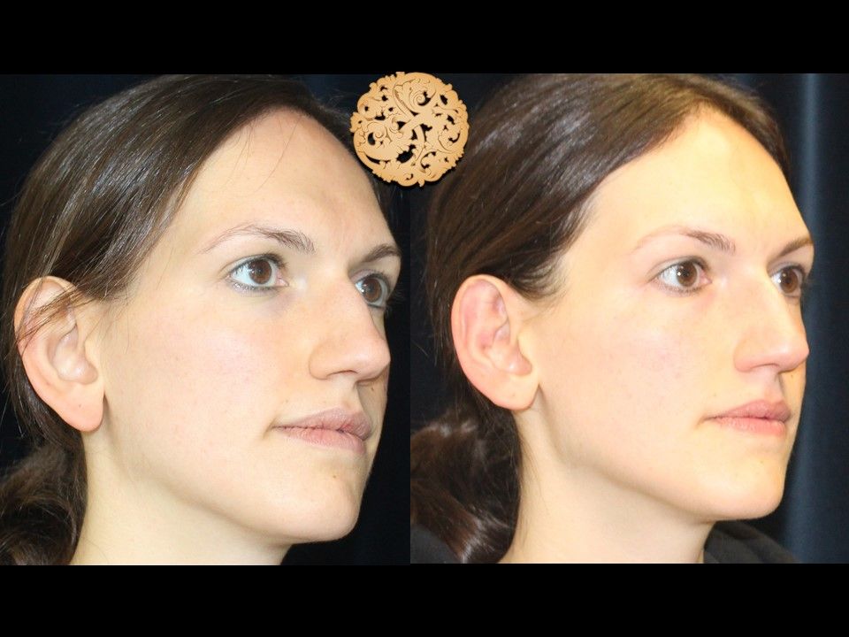 Otoplasty Before & After