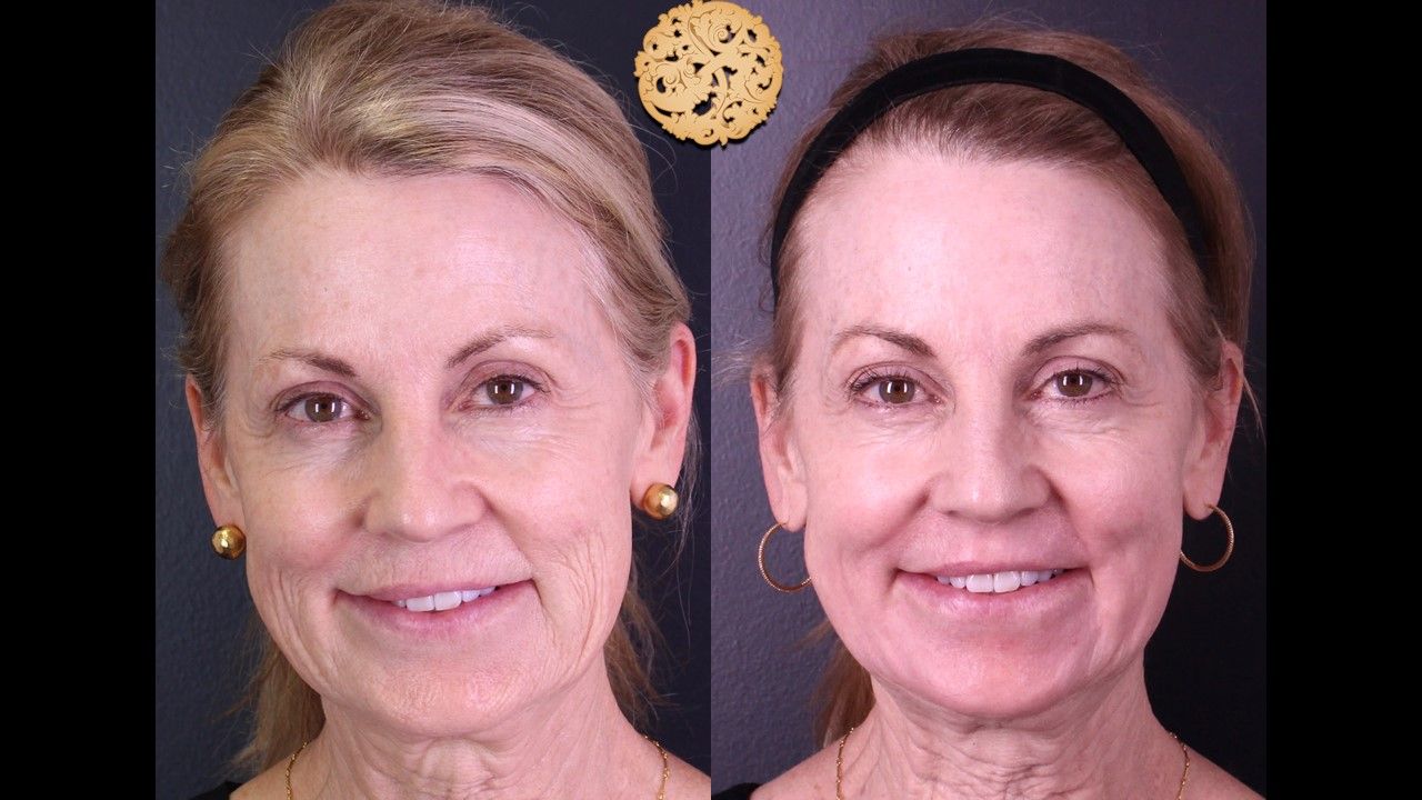 Liquid Facelift Before & After
