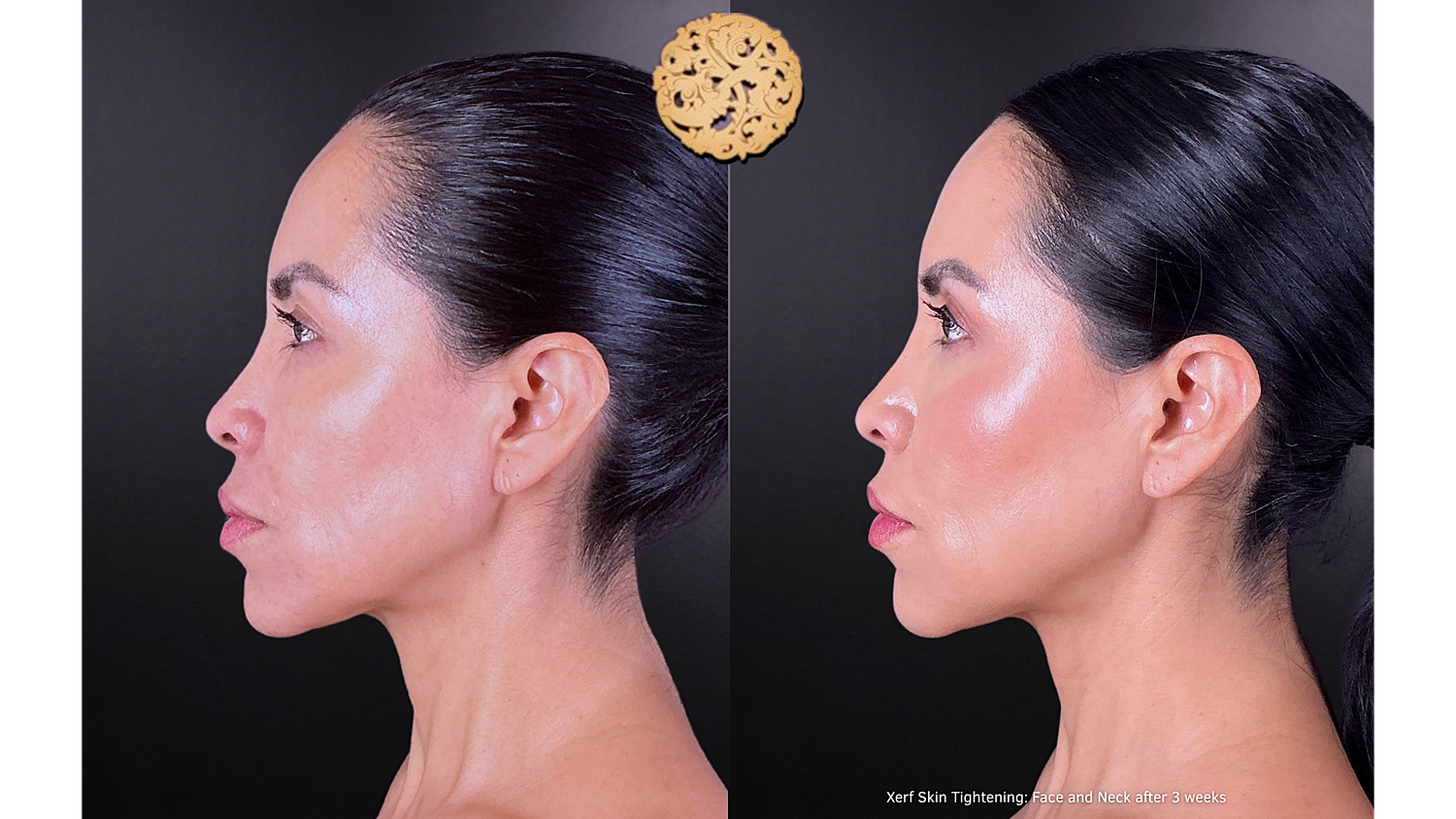 Xerf: Skin Tightening Before & After
