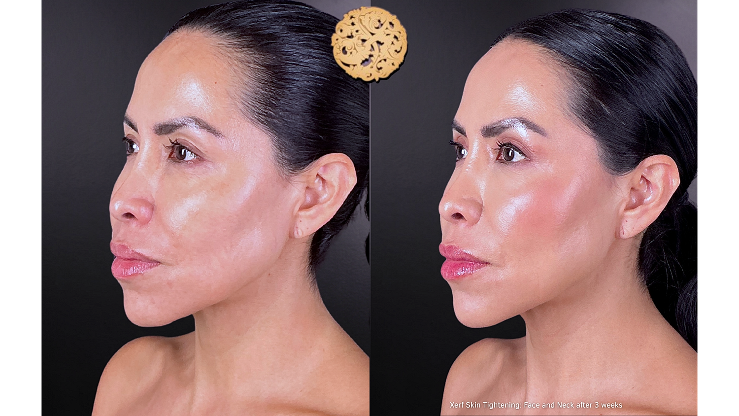 Xerf: Skin Tightening Before & After