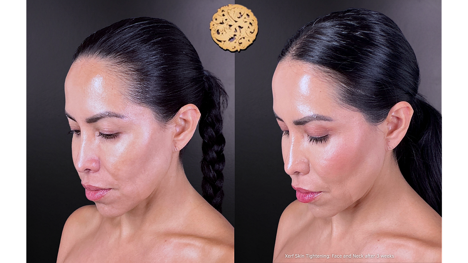 Xerf: Skin Tightening Before & After