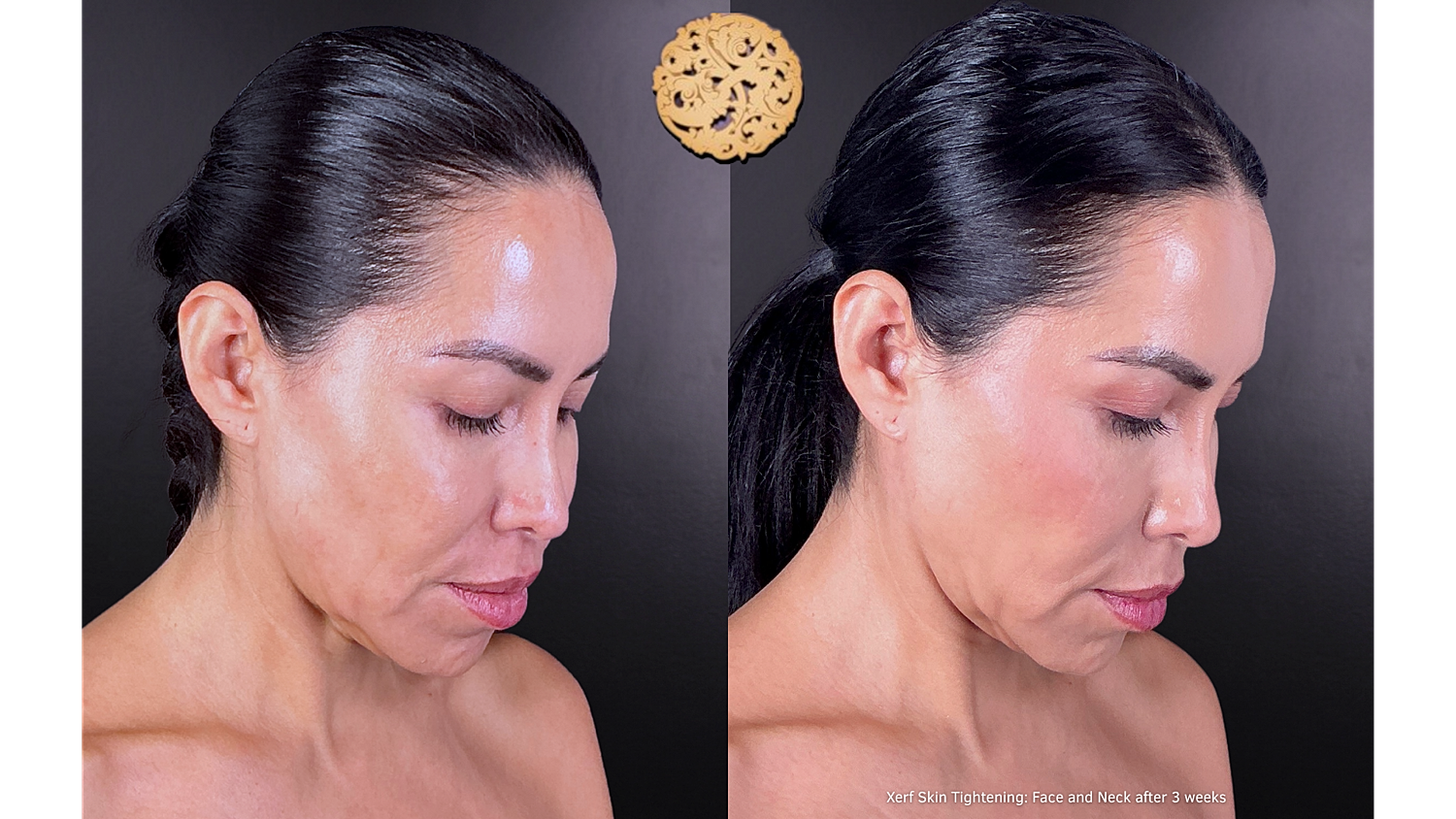 Xerf: Skin Tightening Before & After