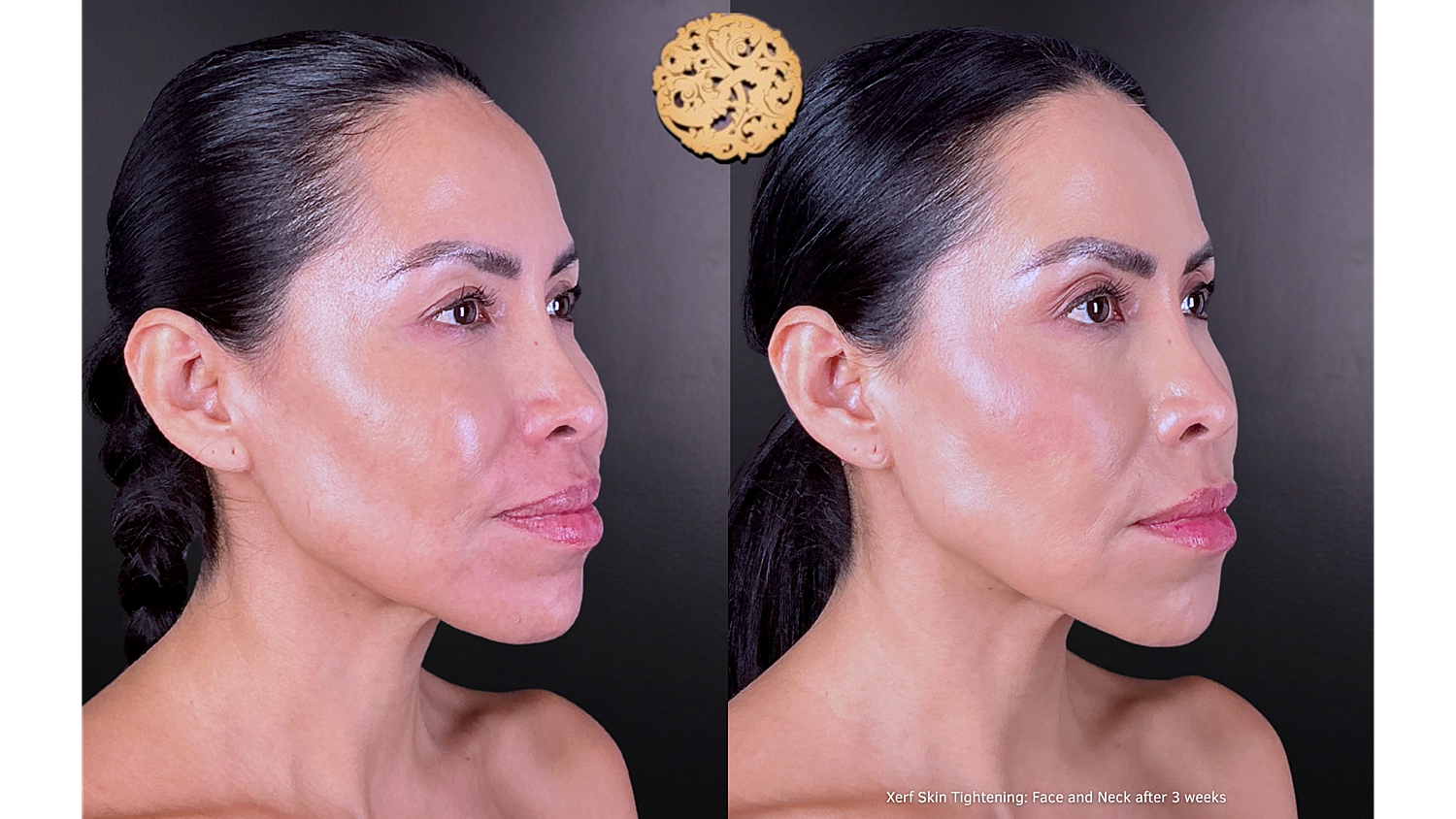 Xerf: Skin Tightening Before & After