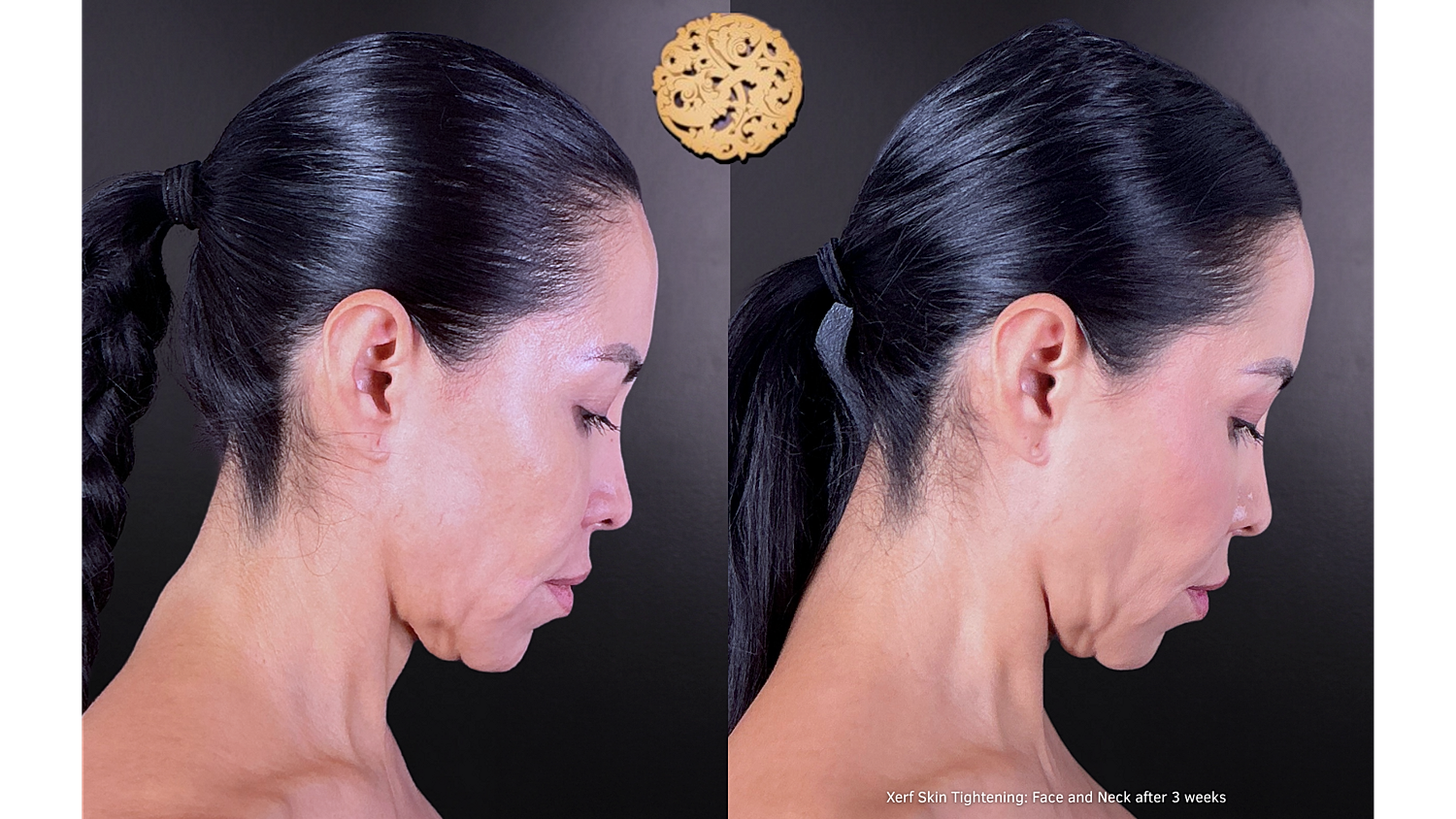 Xerf: Skin Tightening Before & After