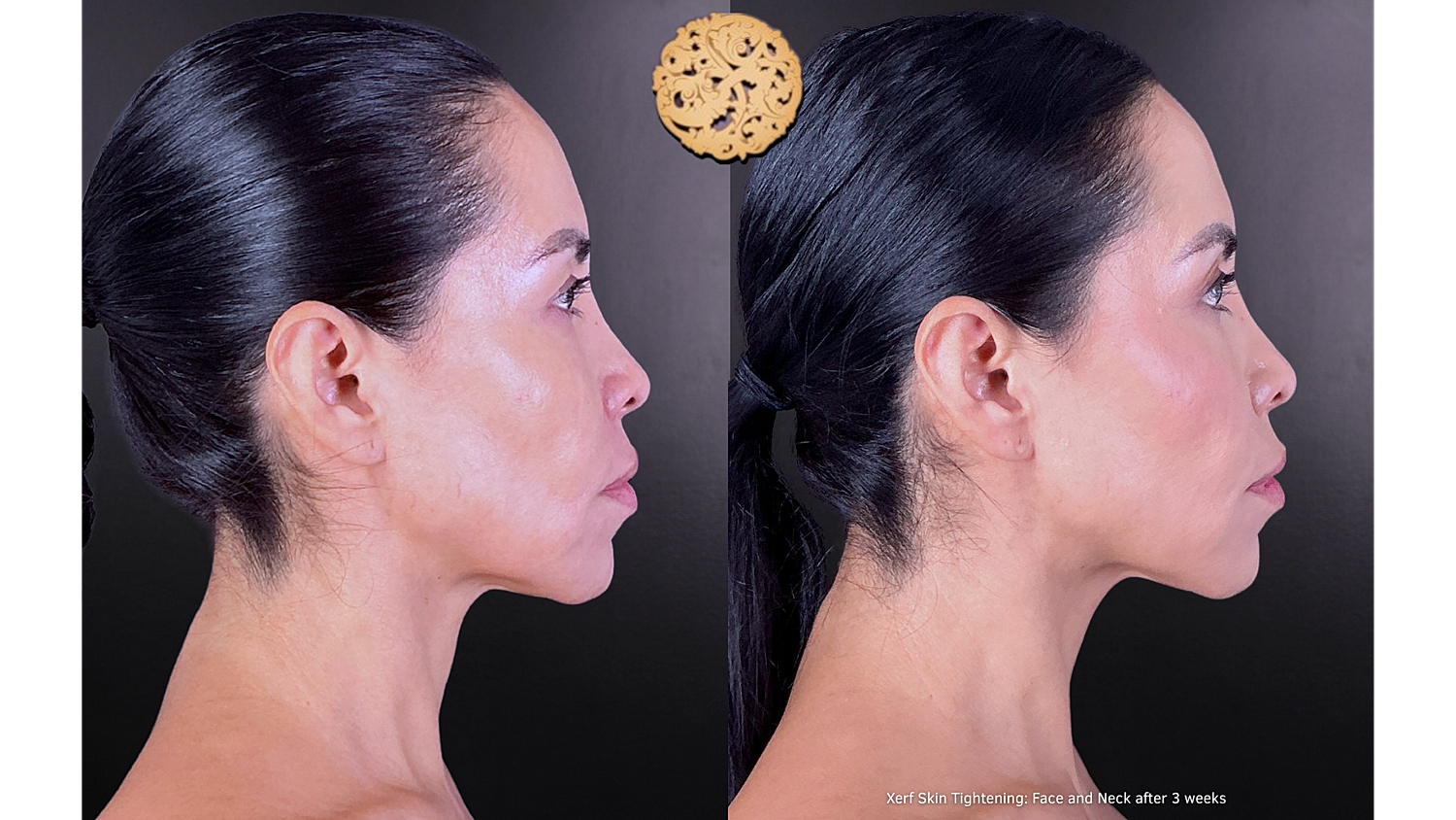Xerf: Skin Tightening Before & After