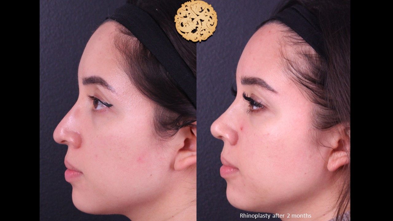Rhinoplasty Before & After