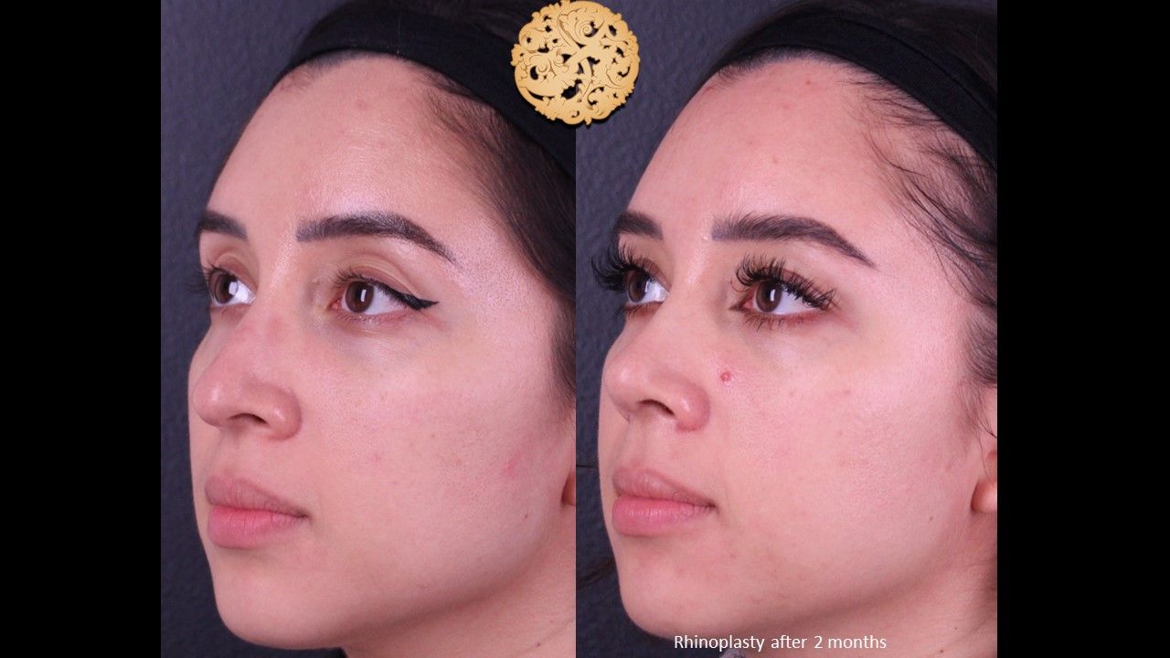 Rhinoplasty Before & After