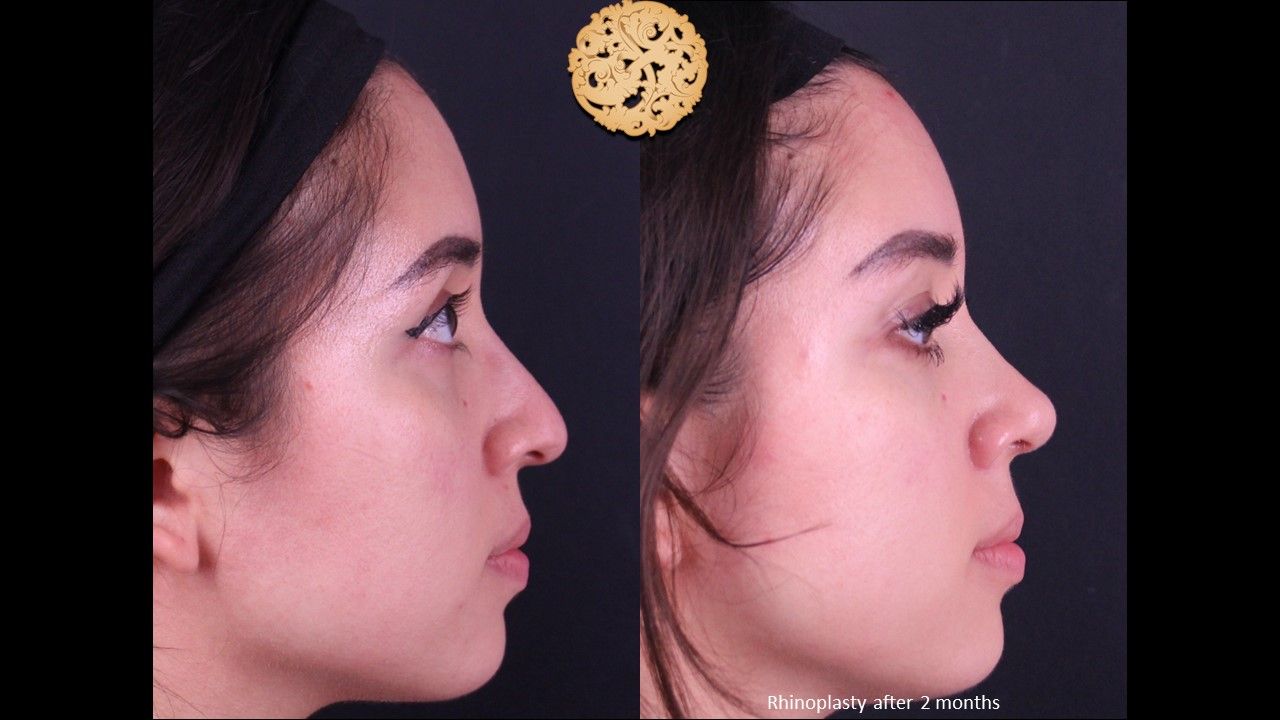 Rhinoplasty Before & After