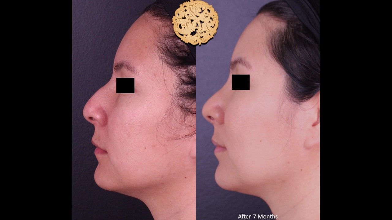 Rhinoplasty Before & After