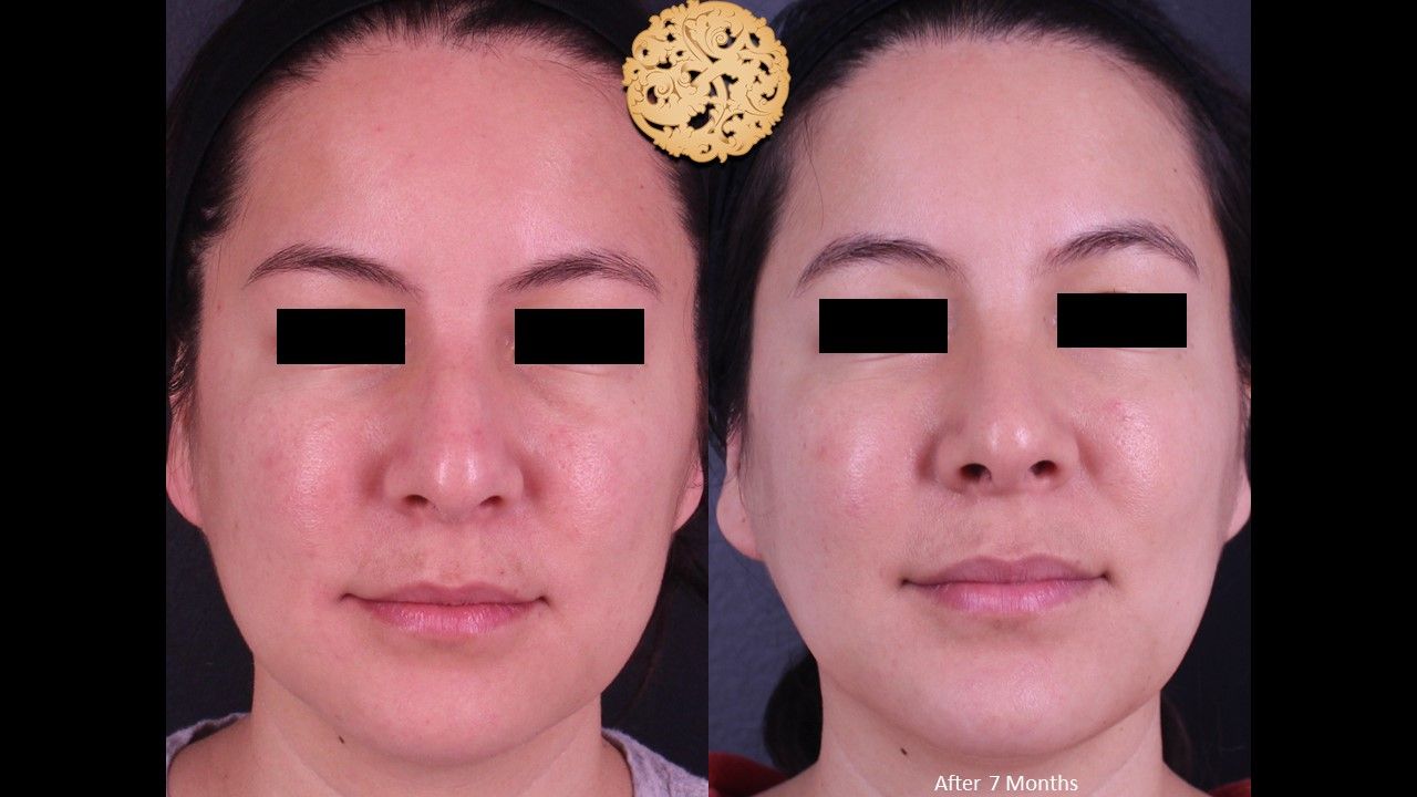 Rhinoplasty Before & After