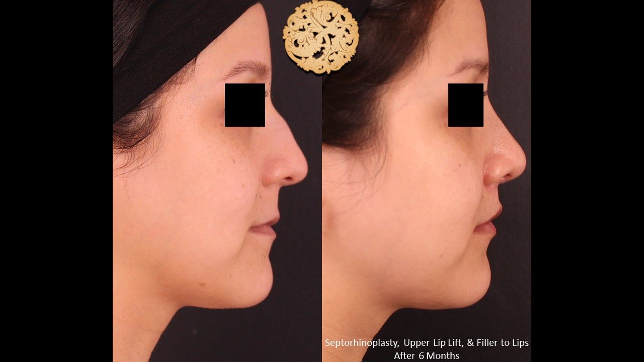 Rhinoplasty Before & After