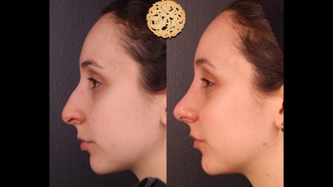 Rhinoplasty Before & After