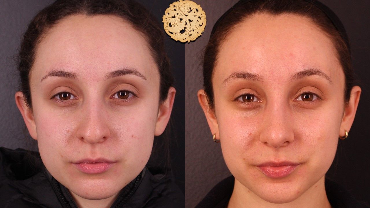 Rhinoplasty Before & After
