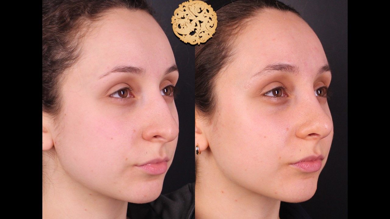 Rhinoplasty Before & After