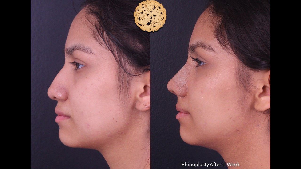 Rhinoplasty Before & After