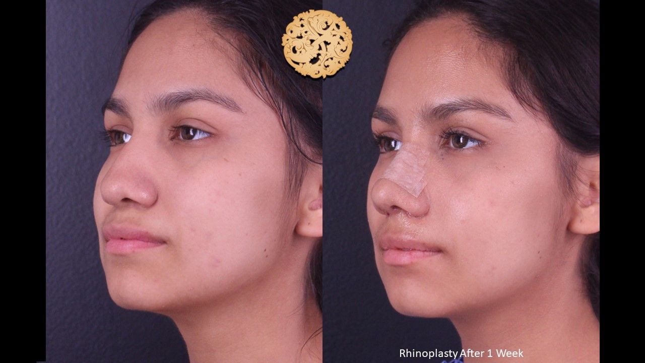 Rhinoplasty Before & After