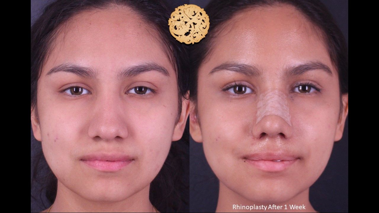Rhinoplasty Before & After