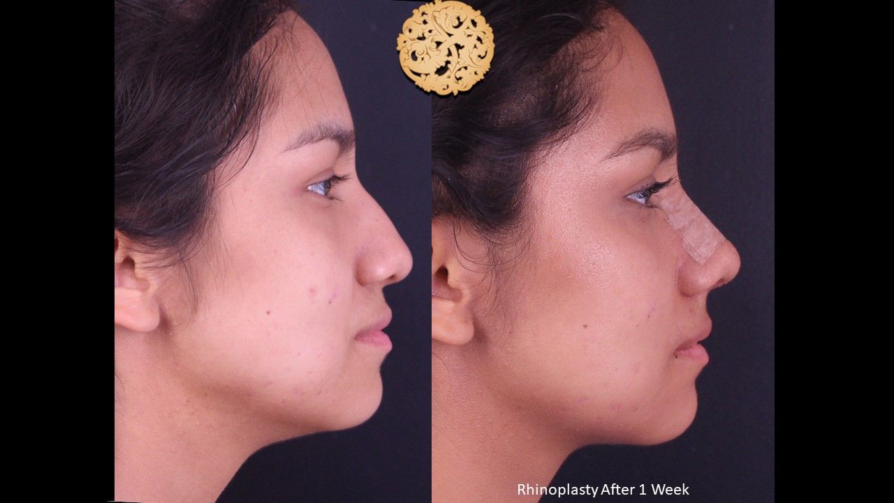 Rhinoplasty Before & After