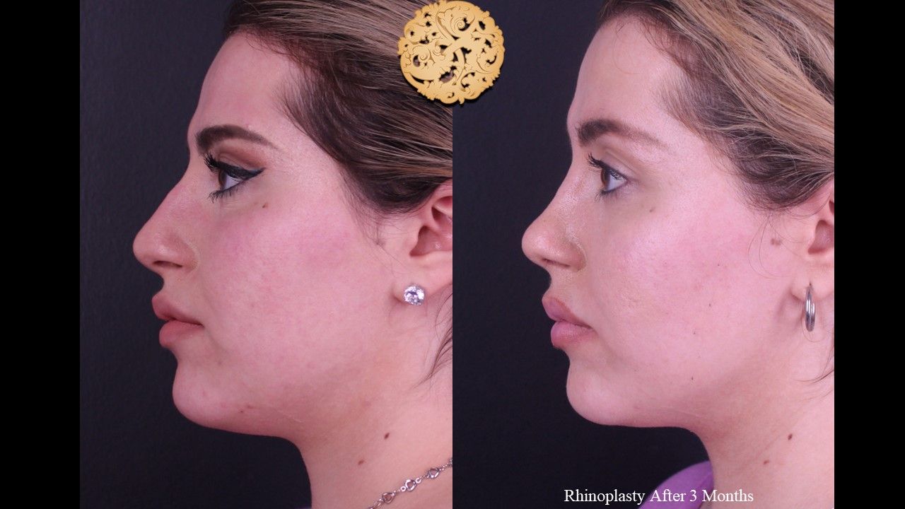 Rhinoplasty Before & After