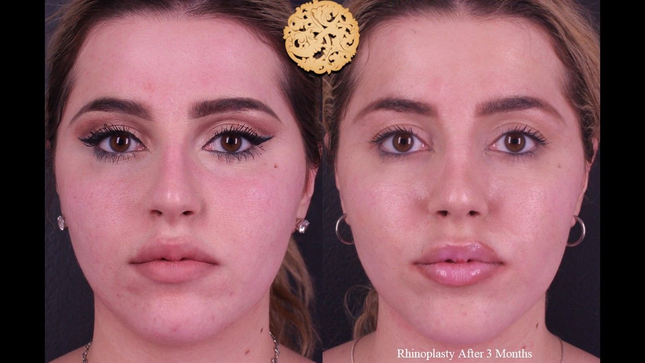 Rhinoplasty Before & After