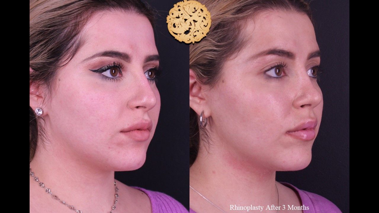 Rhinoplasty Before & After