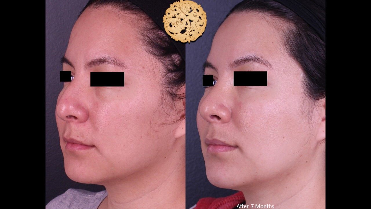 Rhinoplasty Before & After